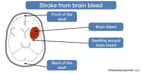 bleked com|brain bleed vs stroke.